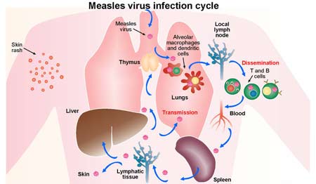 Cơ chế lây truyền và biểu hiện của bệnh sởi