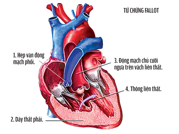 Những cách xử lý khi trẻ bị lên cơn đau tim