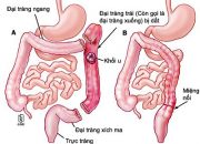 5 CÁCH CHỮA VIÊM ĐẠI TRÀNG DÂN GIAN HIỆU QUẢ NHẤT